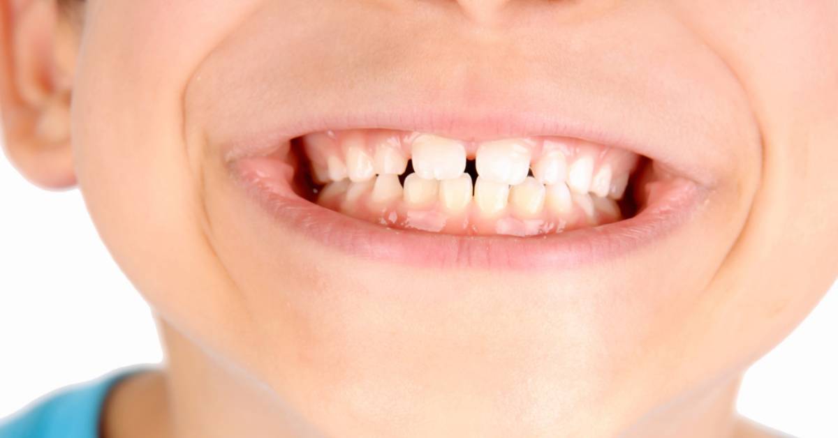 kids-teeth