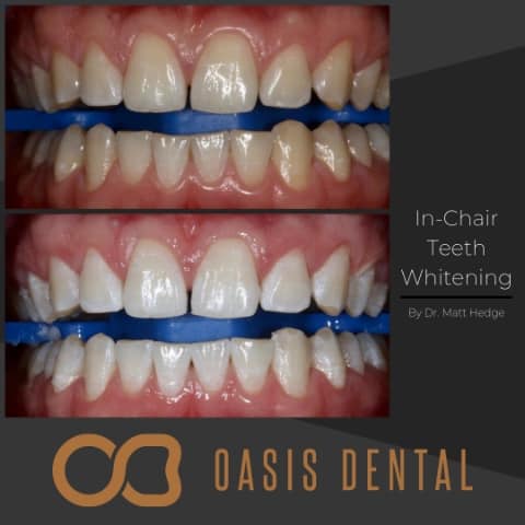 How Does In-Chair Teeth Whitening Work? - 2