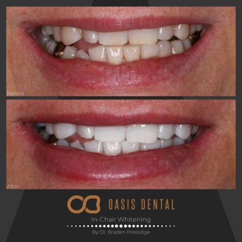 teeth_whitening_gold_coast