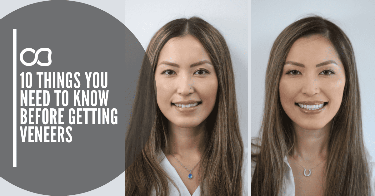 veneers-things-to-know