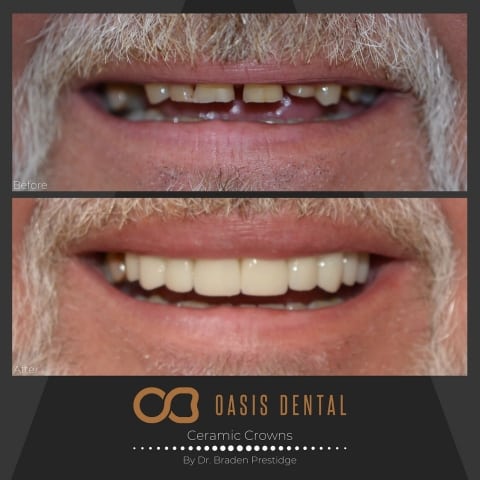 dental-crowns-gold-coast-dentist