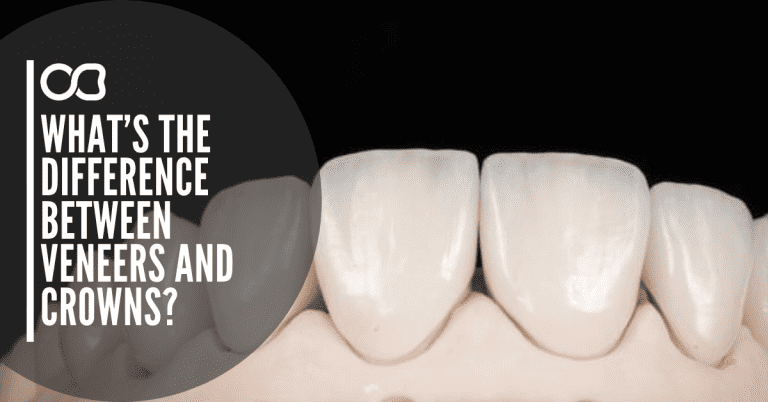 difference-between-veneers-and-crowns