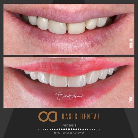 gold-coast-dental-veneers-before-after