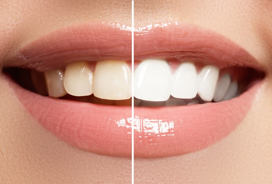 teeth-whitening-before-after