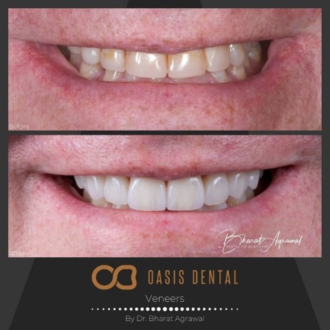 gold-coast-dental-veneers-before-after