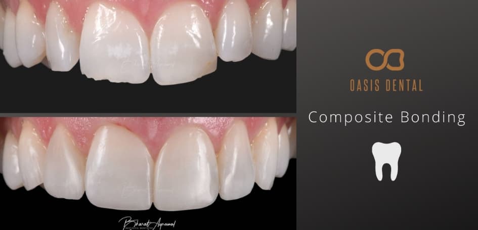 composite-bonding-gold-coast