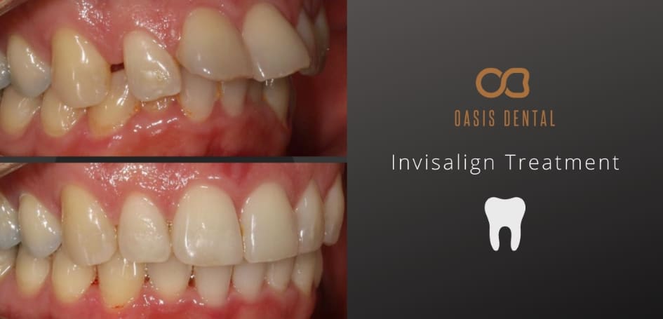 Oasis Dental Studio - 9 Most Common Invisalign Myths - 1 Invisalign Blog Image