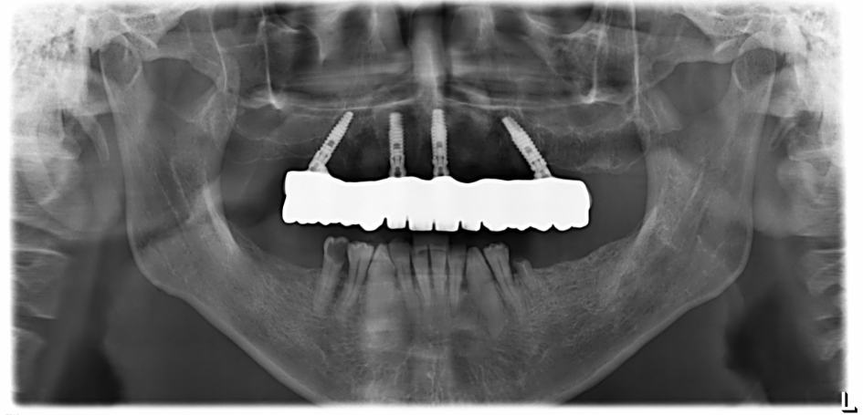 all-on-4-dental-implants-xray
