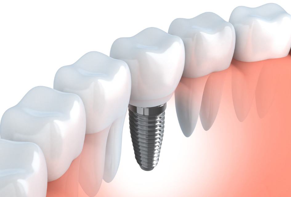 dental-implants