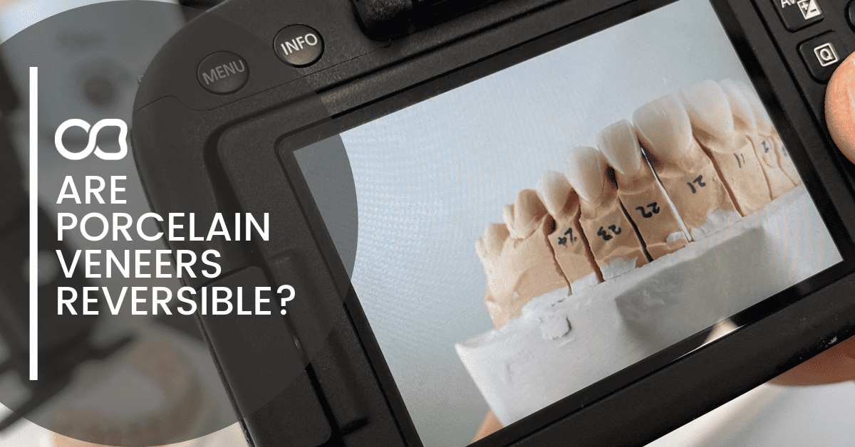 porcelain-veneers-on-camera-screen