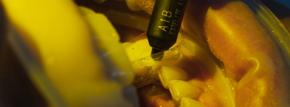 Oasis Dental, a patient during dental crowns and bridges procedure 02