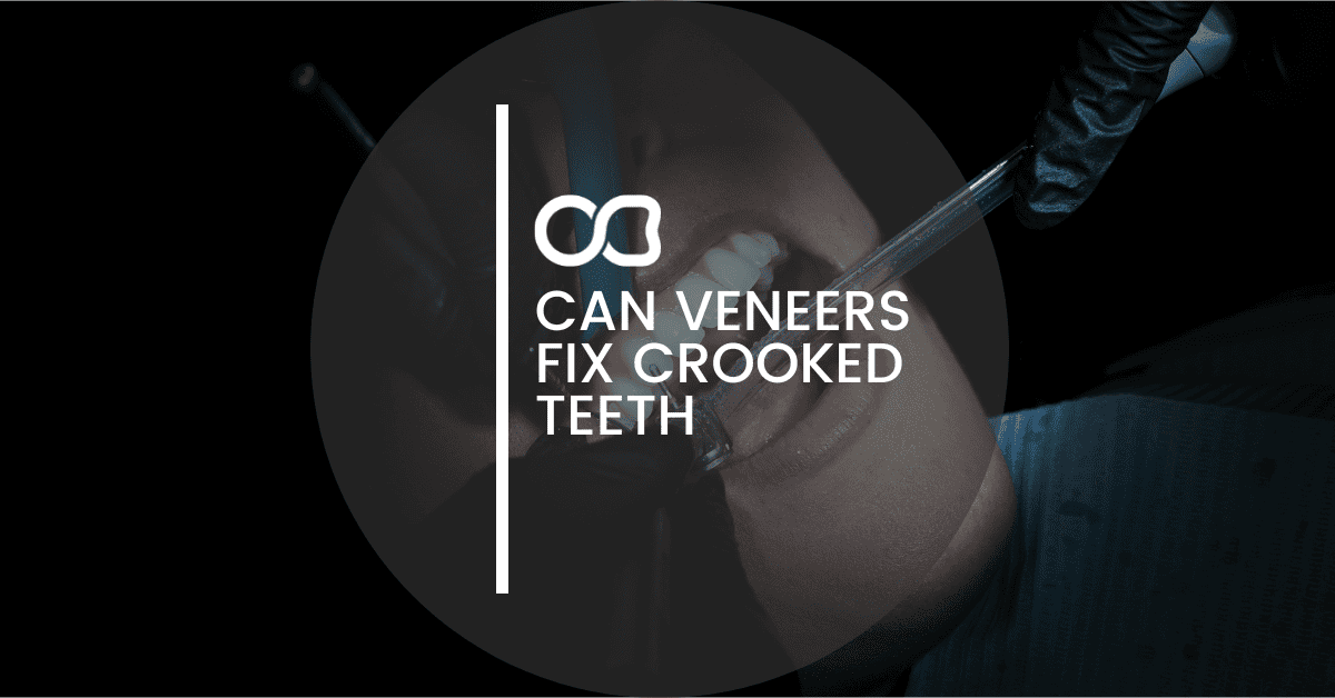 Oasis Dental Studio - Can Veneers Fix Crooked Teeth? - 18 Can Veneers Fix Crooked Teeth? - 17