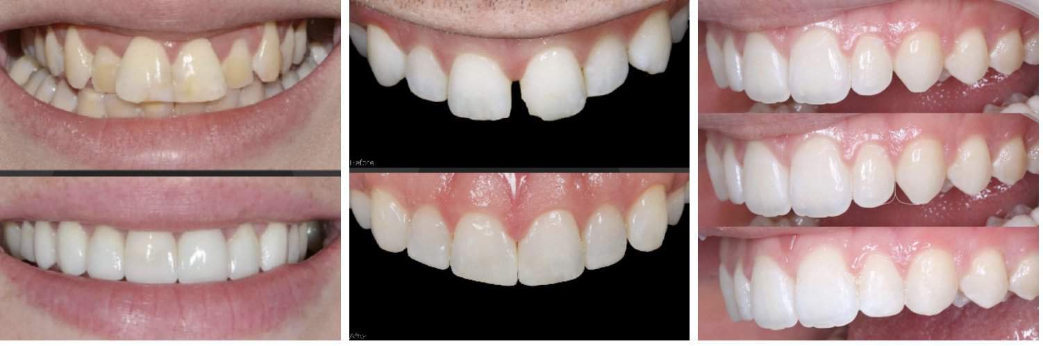 The Truth About Composite and Porcelain Veneers is Here - 1