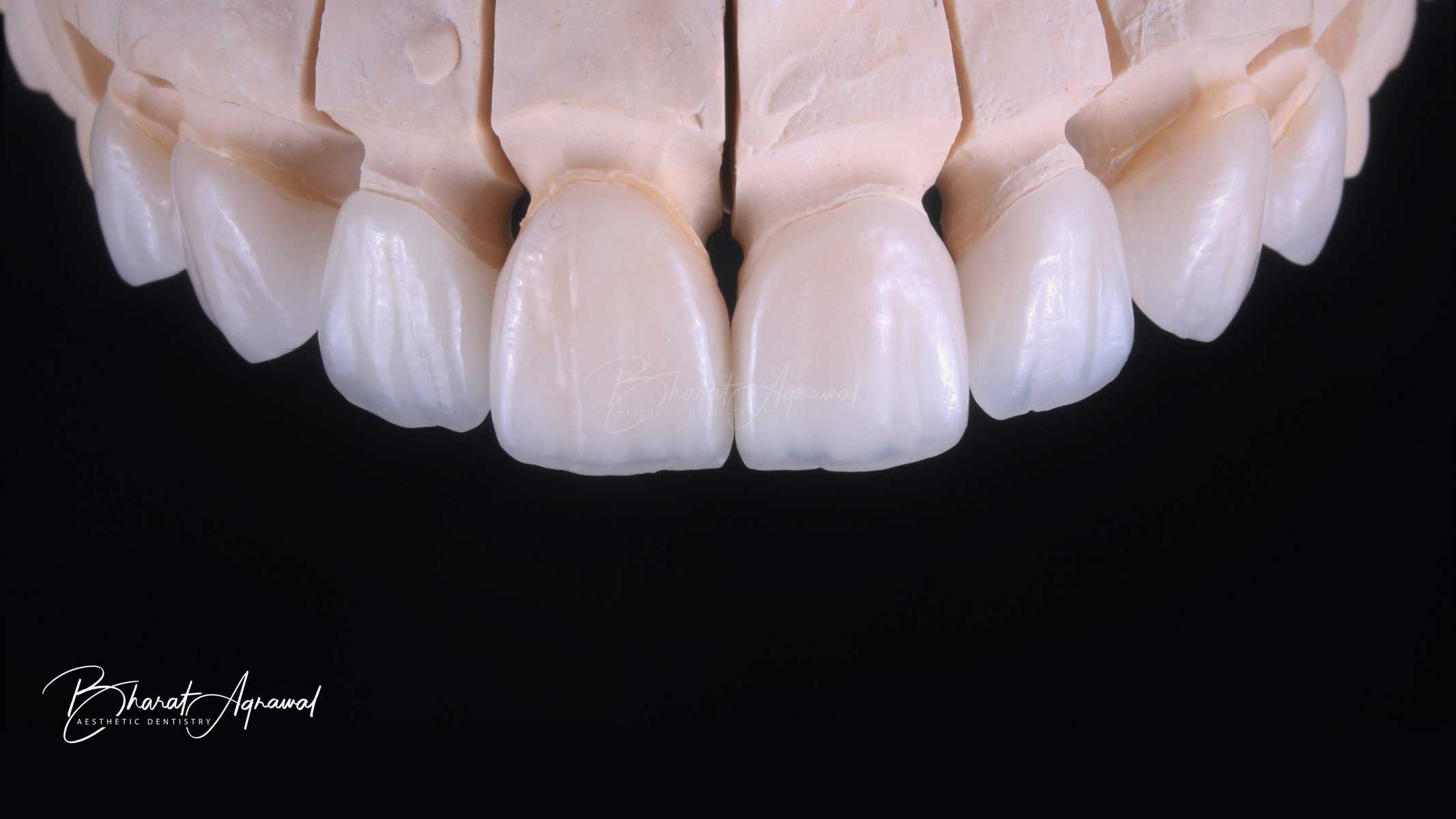 porcelainveneer