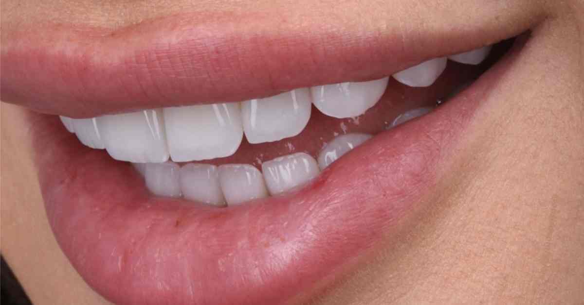 porcelain-veneers-before-after-gold-coast