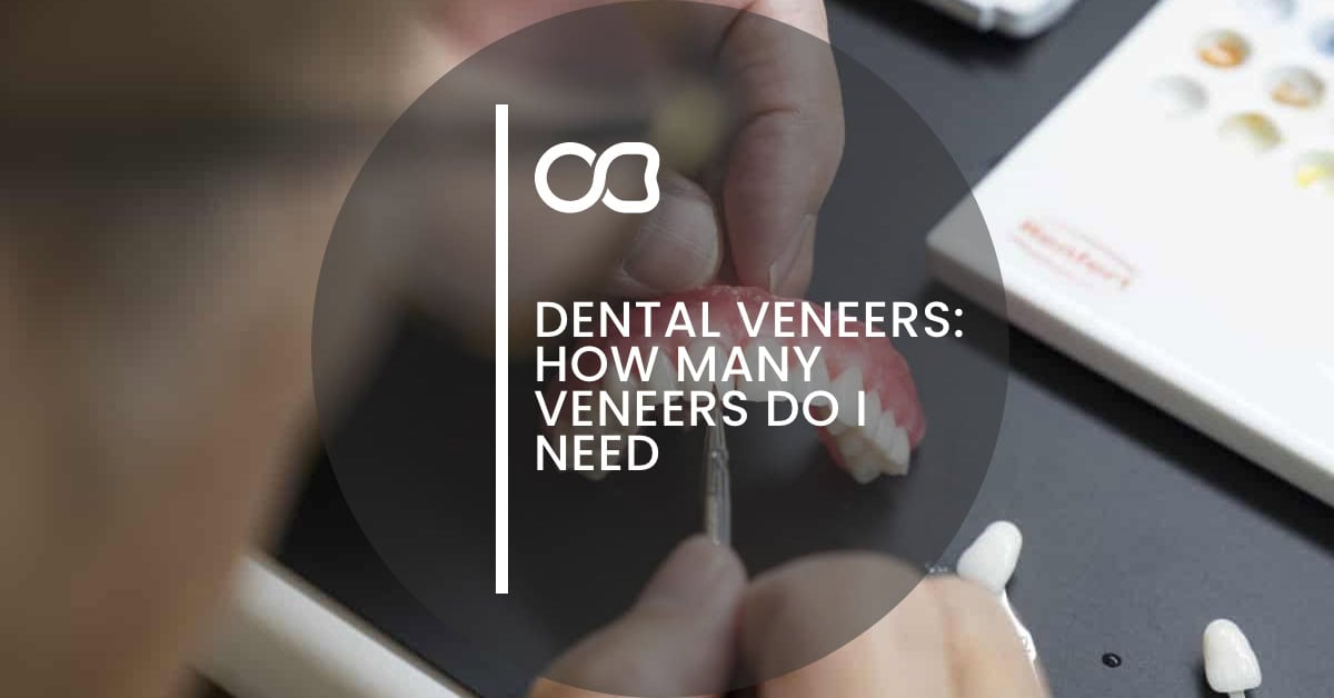 Oasis Dental Studio - Dental Veneers: How Many Veneers Do I Need - 1 Dental veneers, how many, blog 01