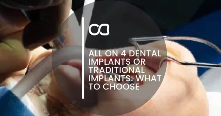 All On 4 Dental Implants or Traditional Implants: What To Choose, blog 1