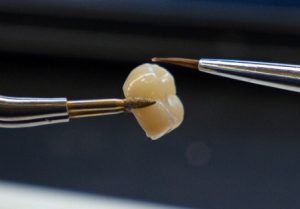 Cracked tooth 01, Osasis Dental Studio Gold Coast, Brisbane, Potsville and Melbourne