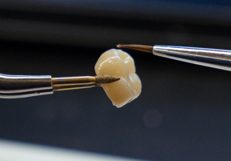 Cracked tooth 01, Osasis Dental Studio Gold Coast, Brisbane, Potsville and Melbourne