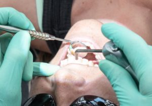 Tooth erosion 1-2, dental conditions, ODS Gold Coast, Brisbane, Potsville and Melbourne