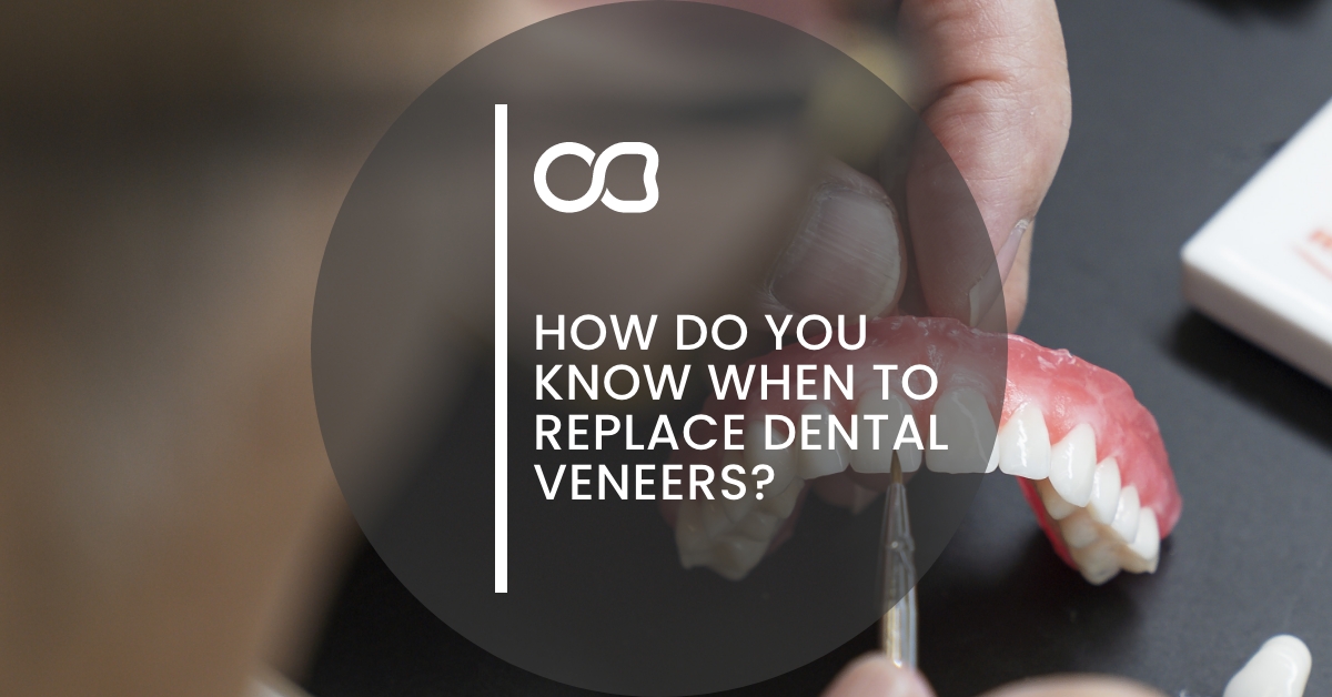How do you know when to replace dental veneers, blog 1, ODS