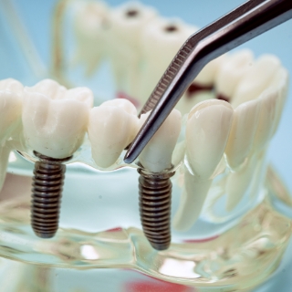 Missing teeth (Hypodontia), 1, ODS
