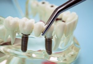 Missing teeth (Hypodontia), 1-4, ODS