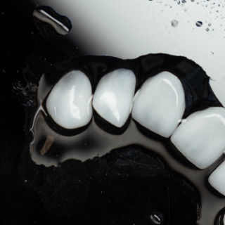 Small Teeth (Microdontia) 2, Oasis Dental Studio